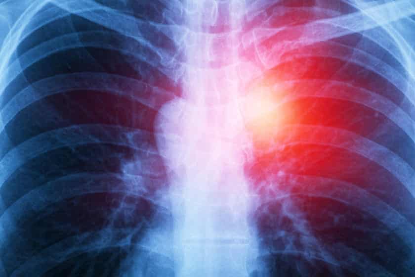 human chest x-ray personal injury